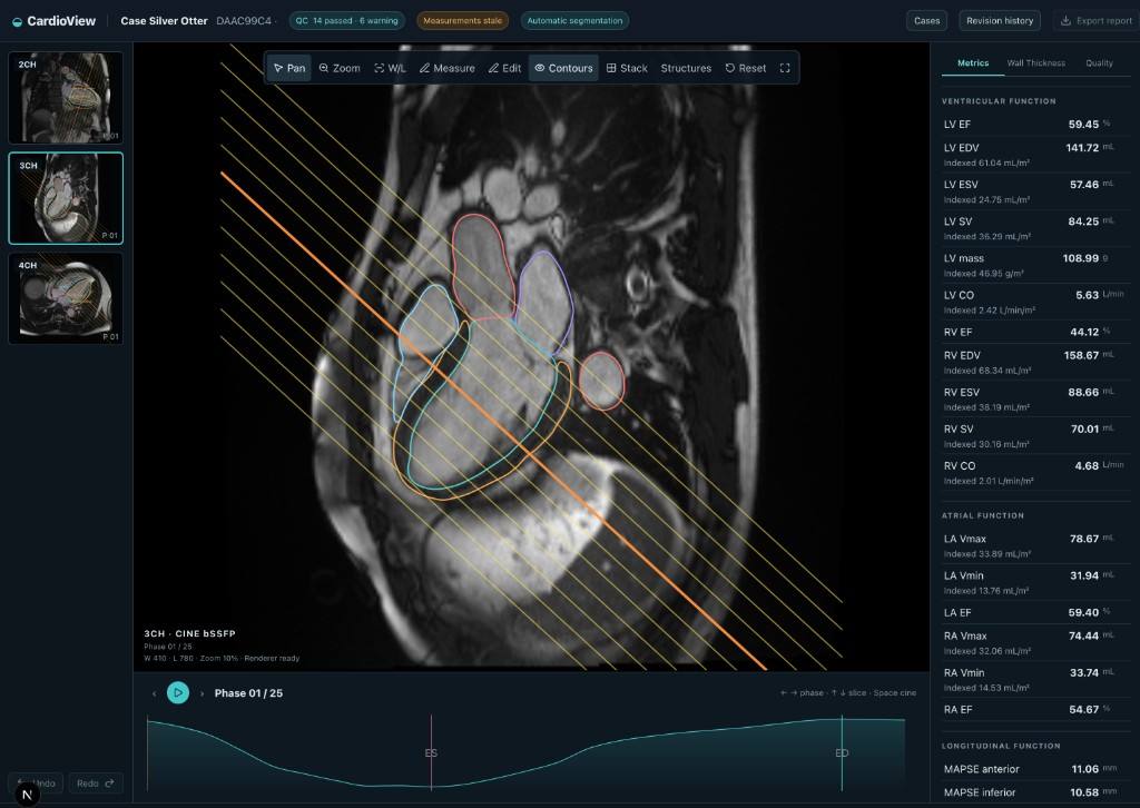 CardioVisum case viewer with long-axis cine contours, metrics, and cardiac-cycle timeline